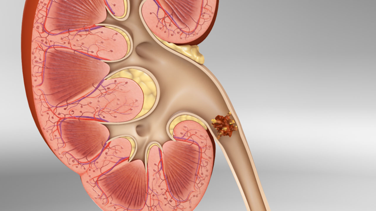 4 Common Myths About Kidney Stones That You Need to Stop Believing